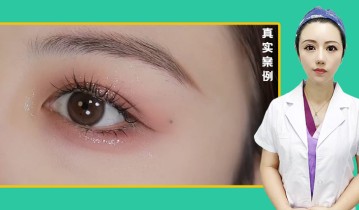 徐丽芬医生-眼综合双眼皮效果