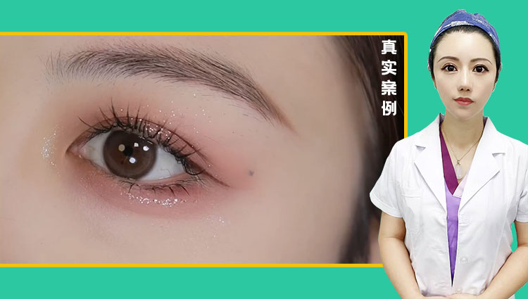 徐丽芬医生-眼综合双眼皮效果