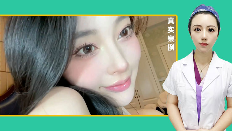 黄金媚眼重睑术效果【2】