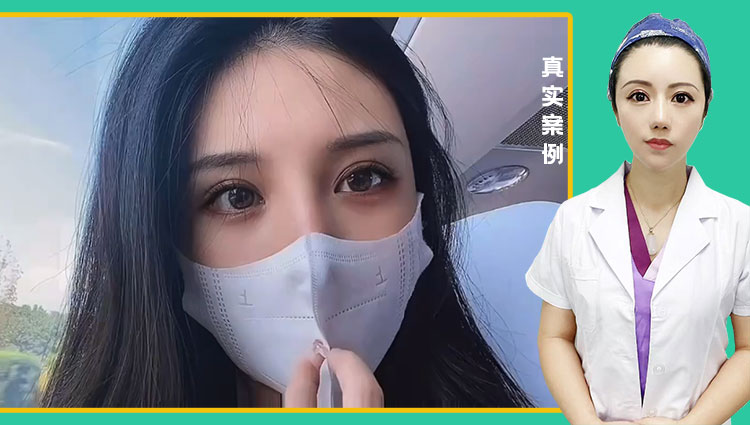徐丽芬医生-黄金媚眼重睑术效果